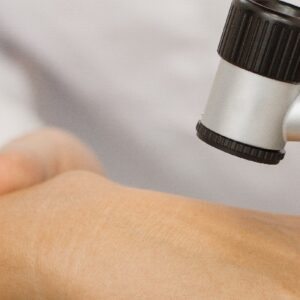 Dermatoscope examining skin on hand